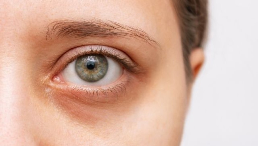 Comment réduire les cernes ?