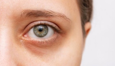 Comment réduire les cernes ?