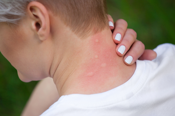 Comment soulager les piqûres de moustiques ?