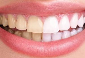 Testez gratuitement le kit de blanchiment dentaire Plastimea