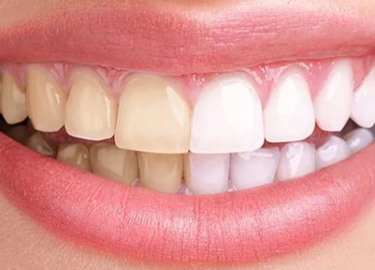 Testez gratuitement le kit de blanchiment dentaire Plastimea